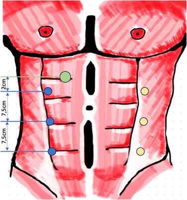 Robot-Assisted Extraperitoneal Ventral Hernia Repair—Experience From the First 160 Consecutive Operations With Lateral eTEP and eTAR Techniques